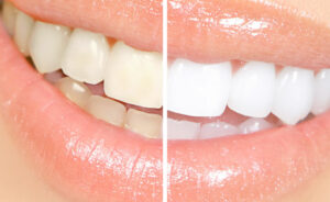 Stained Teeth & Teeth Cleaning