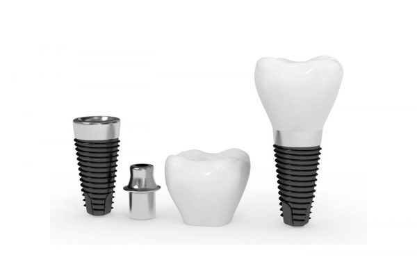 Dental-Implants-1.jpg