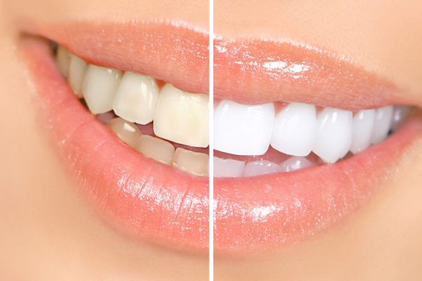 Teeth-Whitening.jpg